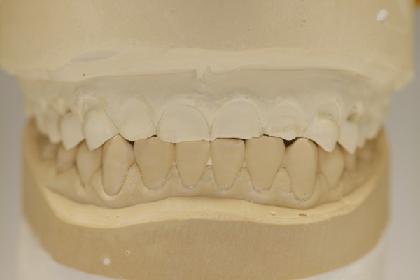 Dental Kontor - Snap-On Platte eckig ohne Neodym-Magneten