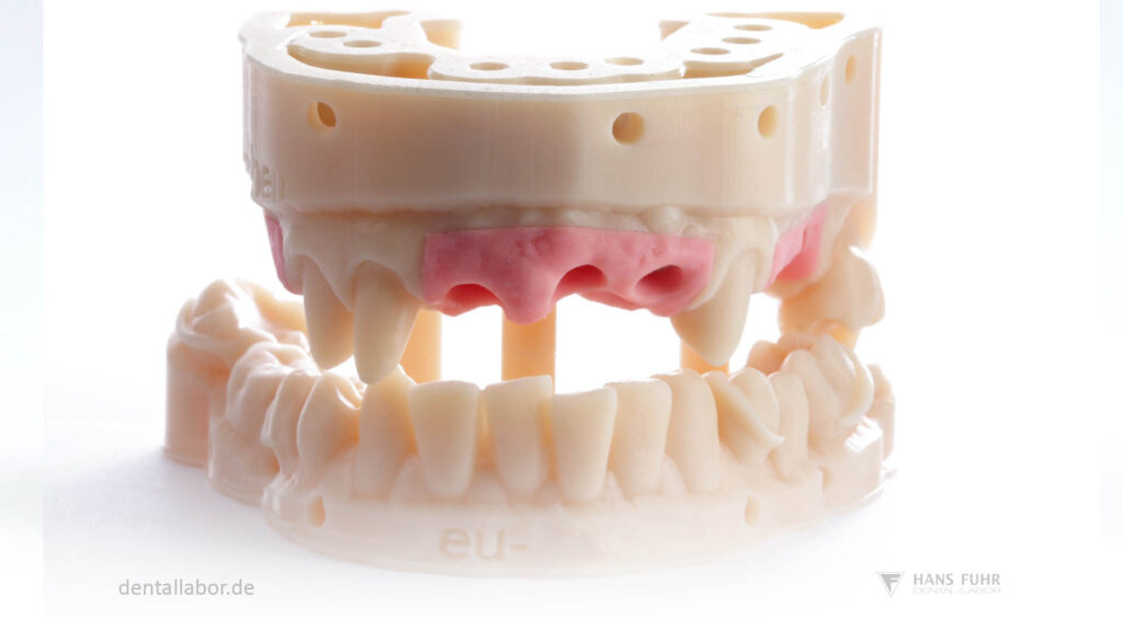 IOS Scan, Intraoralscan, gedrucktes Modell mit Zahnfleischmaske und Implantat Analogen