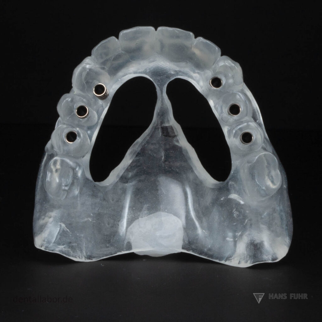 ImplantatBohrschablone, Orientierungsschablone, analog