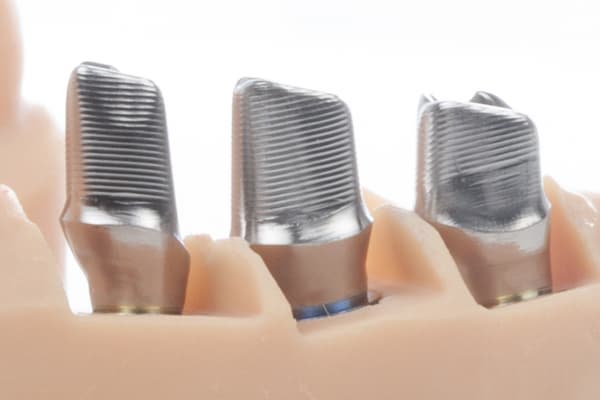 Individuelle Titan Implantat Abutments Atlantis