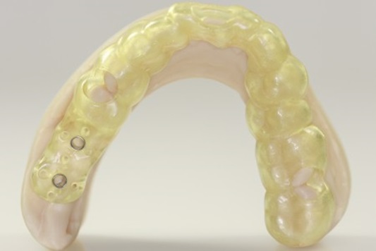 Implantat Bohrschablone gedruckt