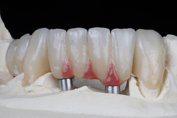 Monolithische Frontzahn Kronen u. Brücken aus Zirkon, teils auf Implantaten, Titel