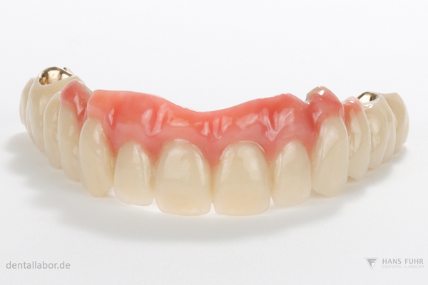 Gaumenfreie, teleskopierende Brücke auf Implantaten