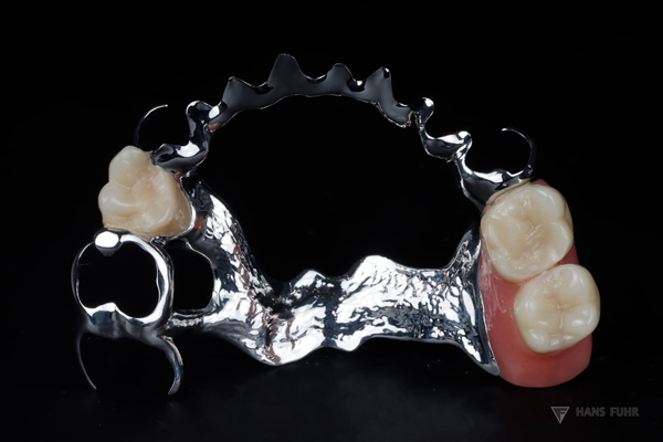 Modellguss mit fortlaufender RS Fräsung, Zahntechnik, Zahnersatz