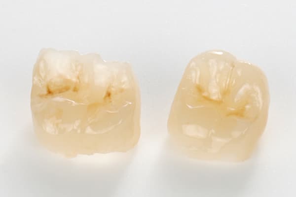 Vollkeramik Teilkronen Onlays Inlays aus e.max Presskeramik